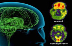 اسکیزوفرنی؛ علایم، تشخیص و درمان
