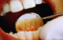 چگونه دندان های سفیدتر و درخشان تری داشته باشیم؟