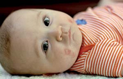 ۵ علت اگزمای نوزادی